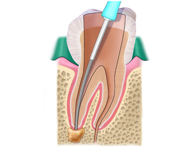 Root Canals: FAQs about treatment that can save your Tooth- treatment at comfortsmiles in Ann Arbor  