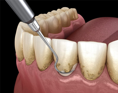 Everything you Need to Know About Scaling and Root Planing- treatment at comfortsmiles in Ann Arbor  