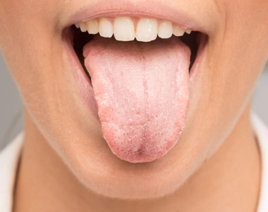 Dry Mouth – Facts and Tips- treatment at comfortsmiles in Ann Arbor  