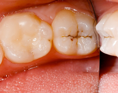 How to Assess Your Risk for Tooth Decay- treatment at comfortsmiles in Ann Arbor  