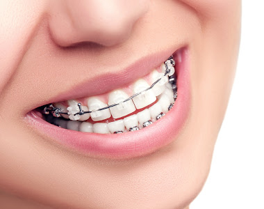 What To Know Before Getting Braces- treatment at comfortsmiles in Ann Arbor  