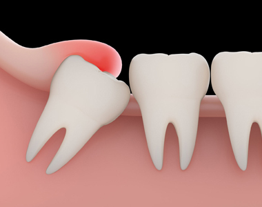 Problems with a Wisdom tooth and when you need to remove them- treatment at comfortsmiles in Ann Arbor  