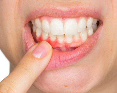 What Causes Receding Gums?- treatment at comfortsmiles in Ann Arbor  